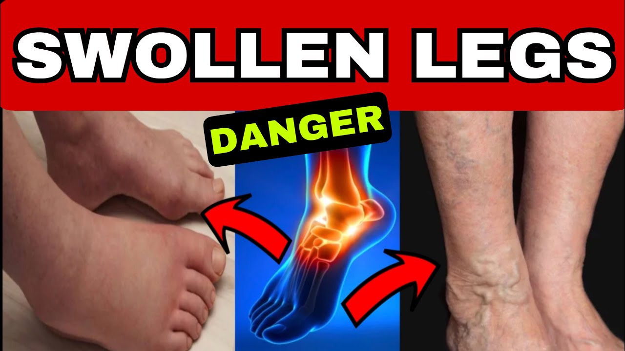 SWOLLEN LEGS | 5 WARNING SIGNS and 9 Causes of Swelling in Feet and Legs