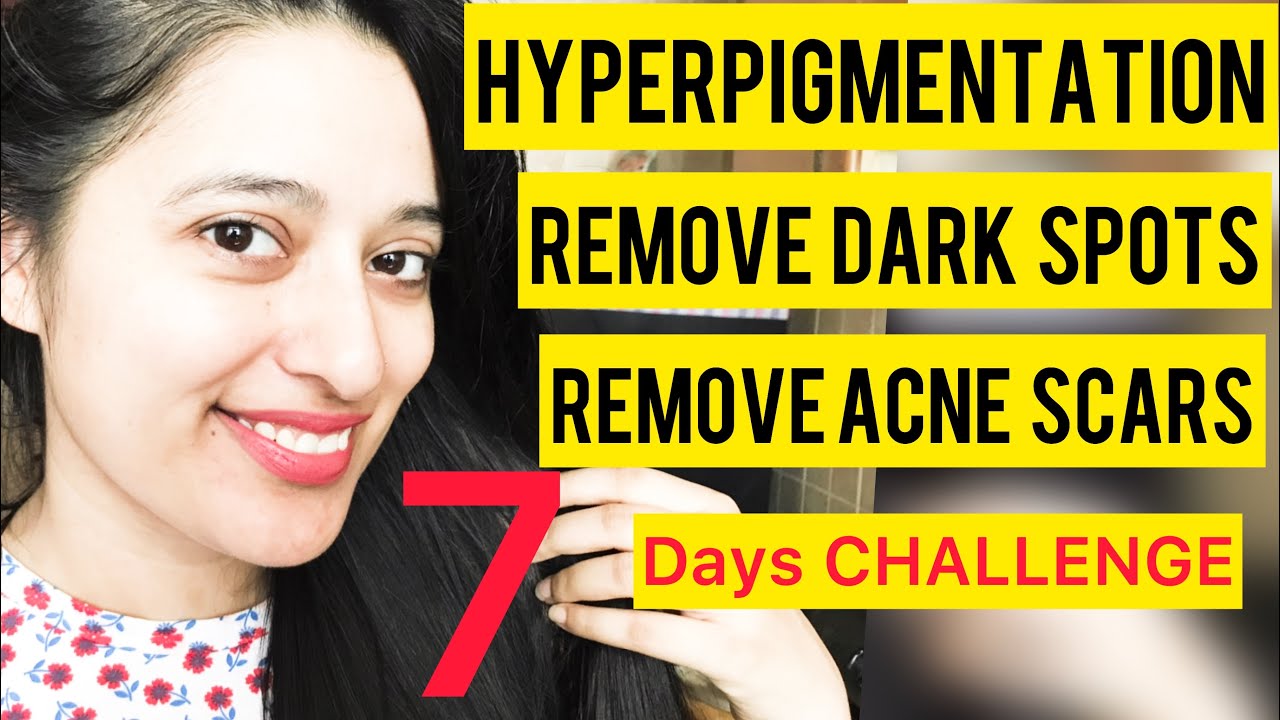Remove dark spots within 7 days || Hyper pigmentation Acne Scars Dark Spots removal face mask