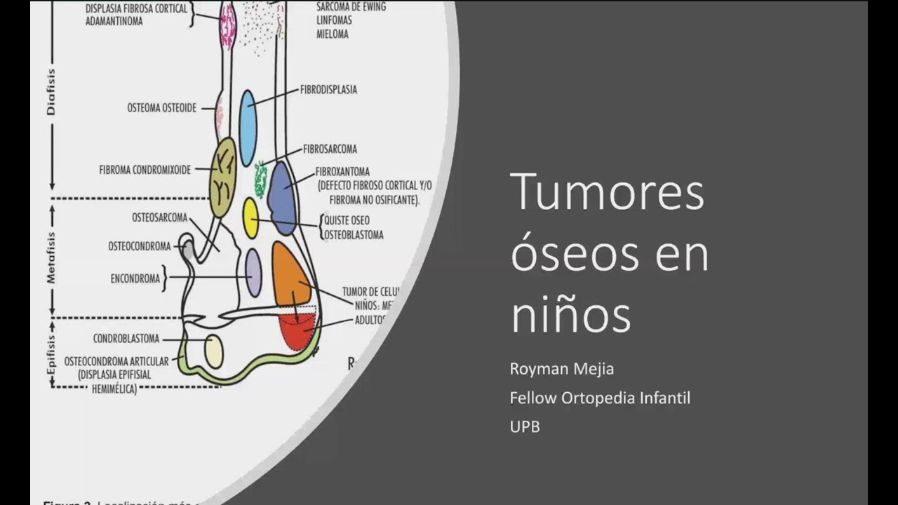 Tumores Óseos en niños - Parte 2