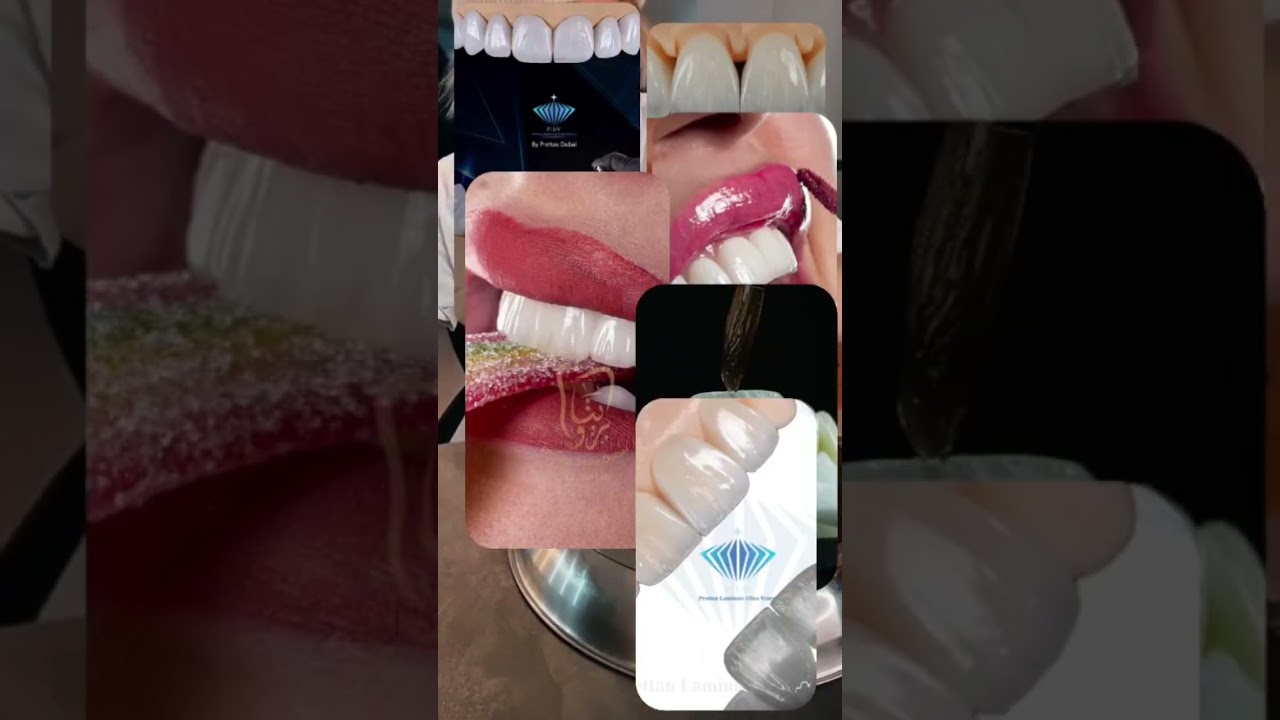 اسنان دكتور بريتاو لصناعة الأسنان #dubai #dentalclinic #smiledesigndental #dentist #dentalprosthesis