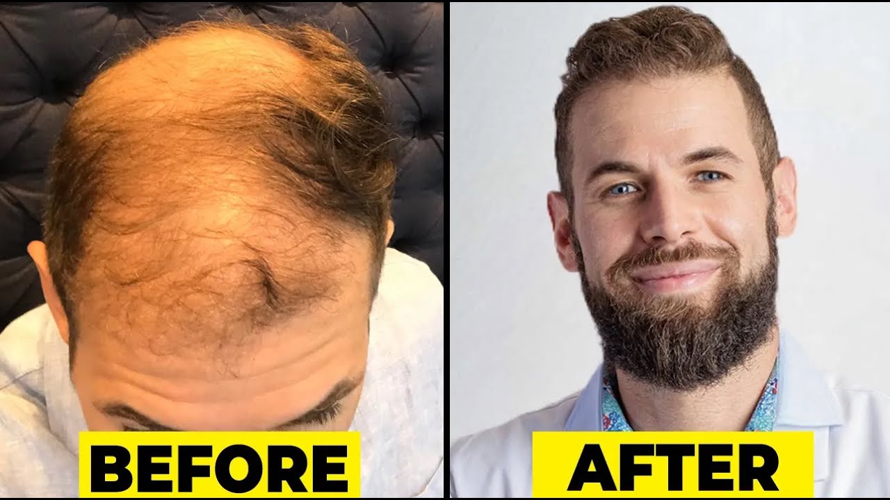 Exactly How I Fixed My Hair Loss w/Stem Cell Therapy (New Method)