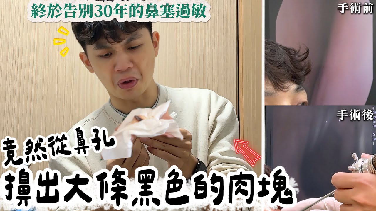 告別30年的鼻塞過敏，下半輩子順暢呼吸！！竟然從鼻孔擤出大條黑色的肉塊，好驚人！真希望早一點這樣做！RPN3鼻塞過敏手術全紀錄【我們倆Ricky&Nina】