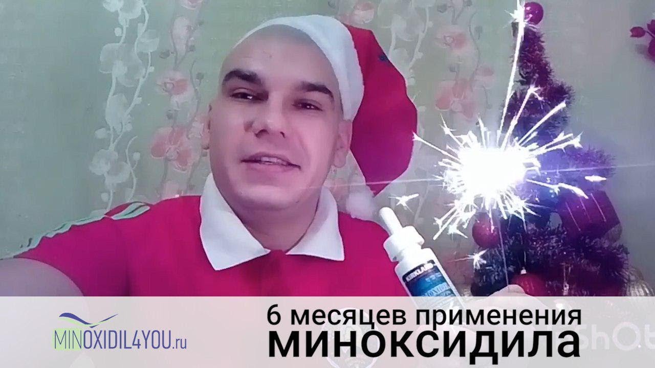 Миноксидил результат применения через 6 месяцев. Отзыв об использовании миноксидила. Minoxidil4you