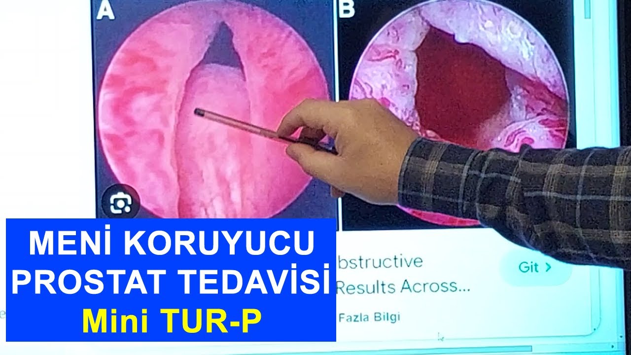 GÜNCEL PROSTAT AMELİYATLARI, Meni Koruyucu Prostat Tedavisi: MİNİ TUR-P ve REZUM