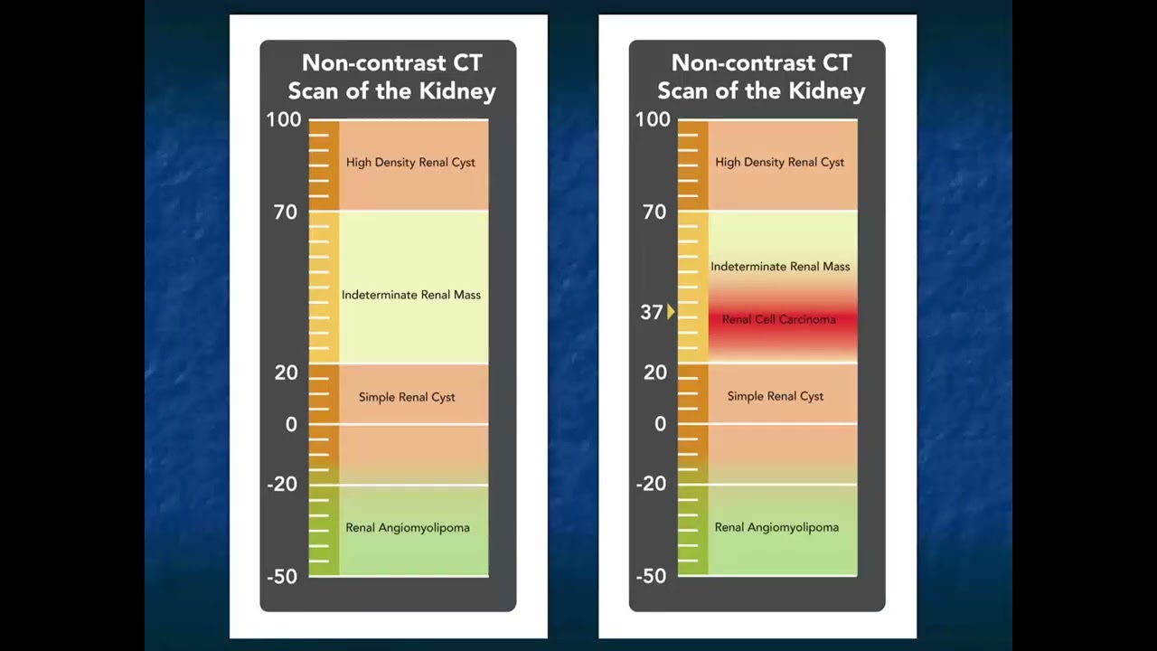 MDCT/CTA Evaluation of the Suspected Renal Mass: Key Differential Diagnosis Points - Part 1