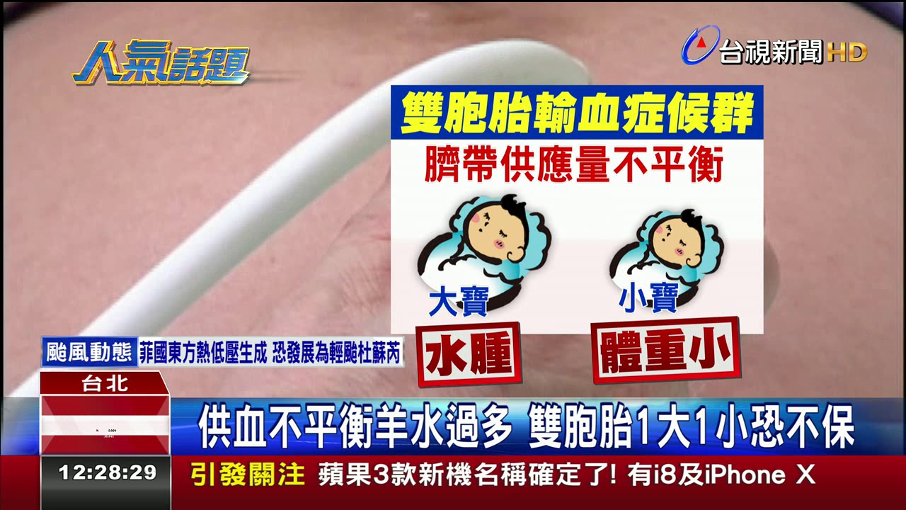 雙胞胎供血失衡輸血症候群腹中治療