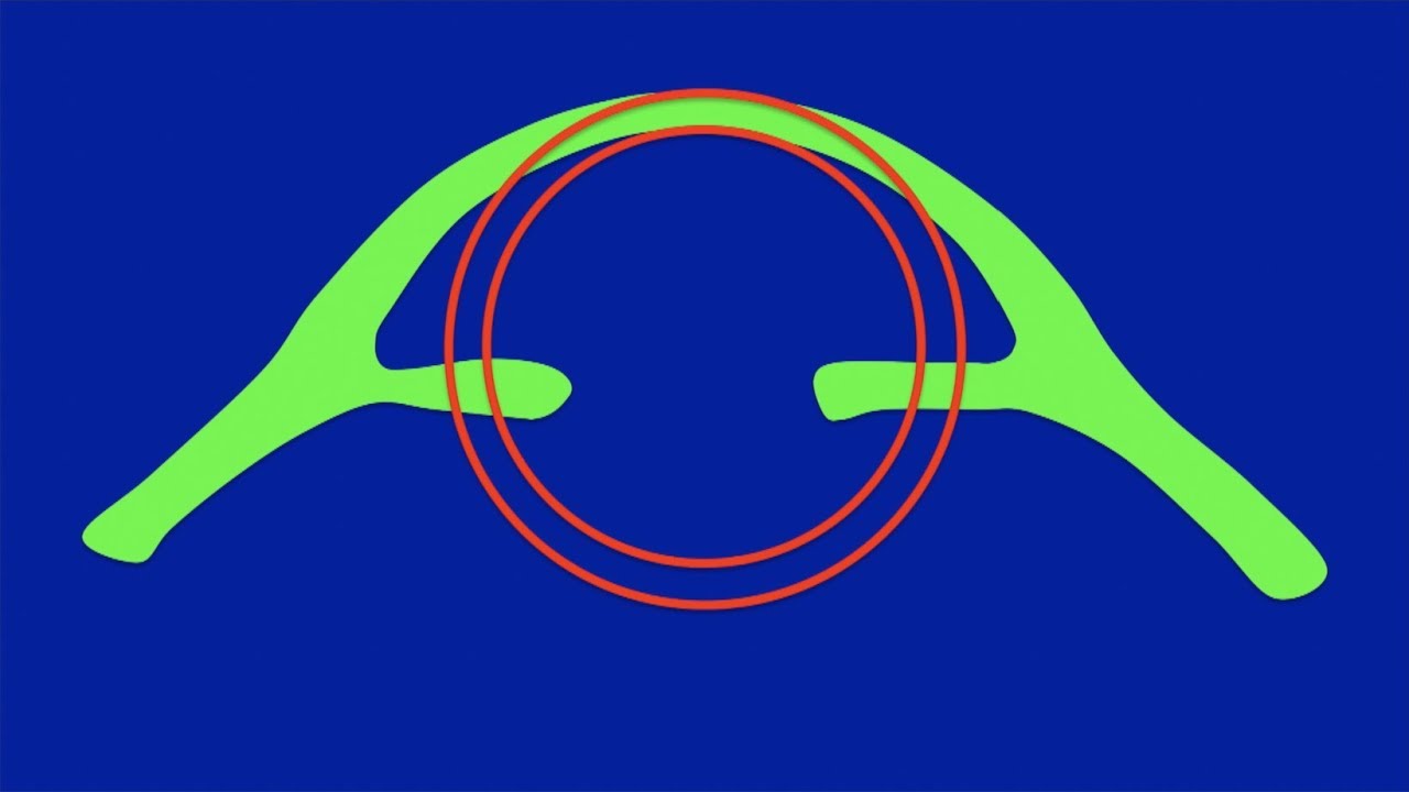 Asfericidad corneal. Figuras esféricas y asféricas. Centro de Oftalmología Bonafonte. Barcelona