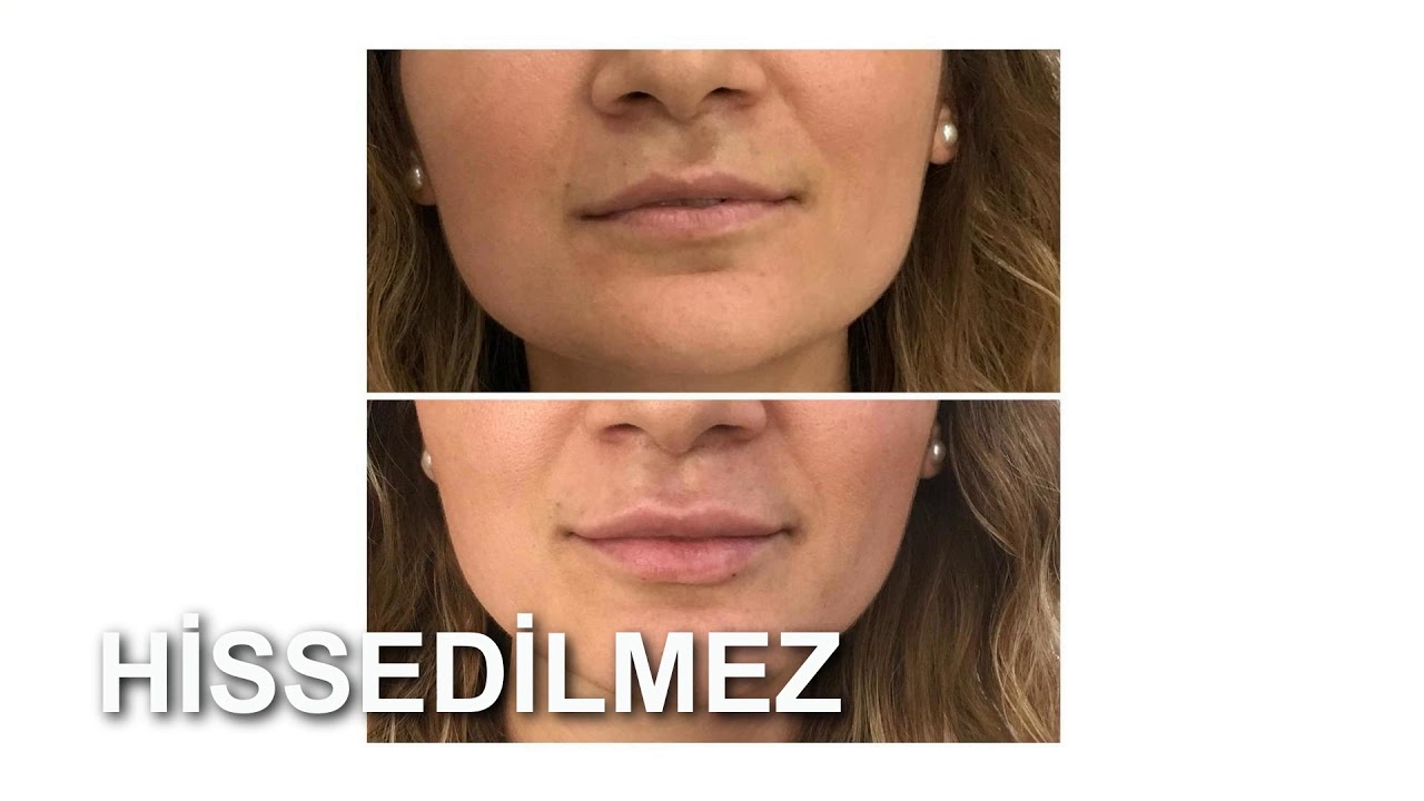 Dudak Dolgusu - French Kiss - Evren G&ouml;keşme - Dermatoloji - Dolgu Uygulamları