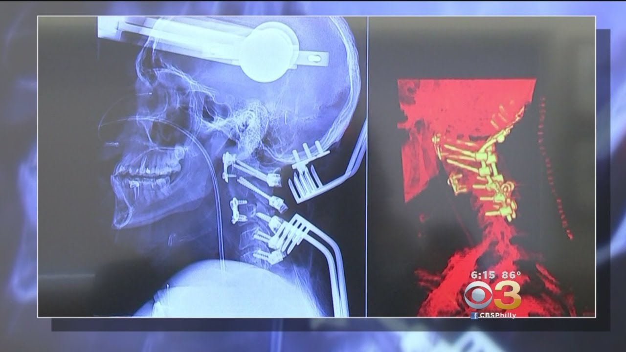 World's First Robot-Assisted Spinal Surgery Performed In Philadelphia