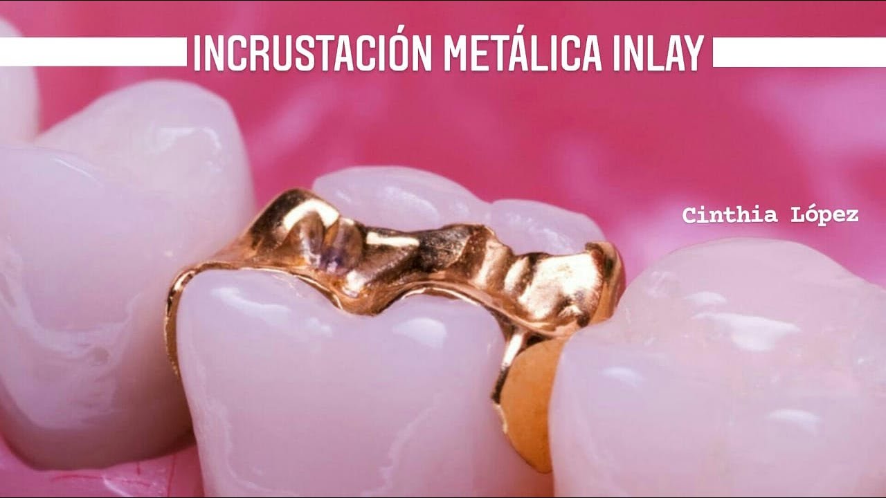 Incrustación Metalica