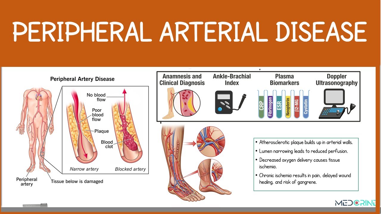 Peripheral Arterial Disease | Risk factors, Classification, Diagnosis and Interventions Simplified