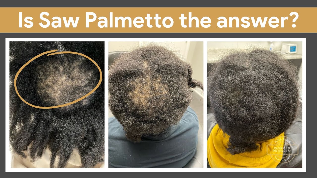 Saw Palmetto: A Game Changer For Hair Loss #sawpalmetto #hairgrowth #hairloss