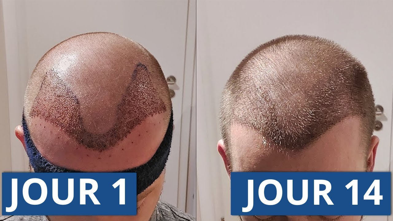 1 - 14 jours après la greffe de cheveux: Le processus de guérison complet