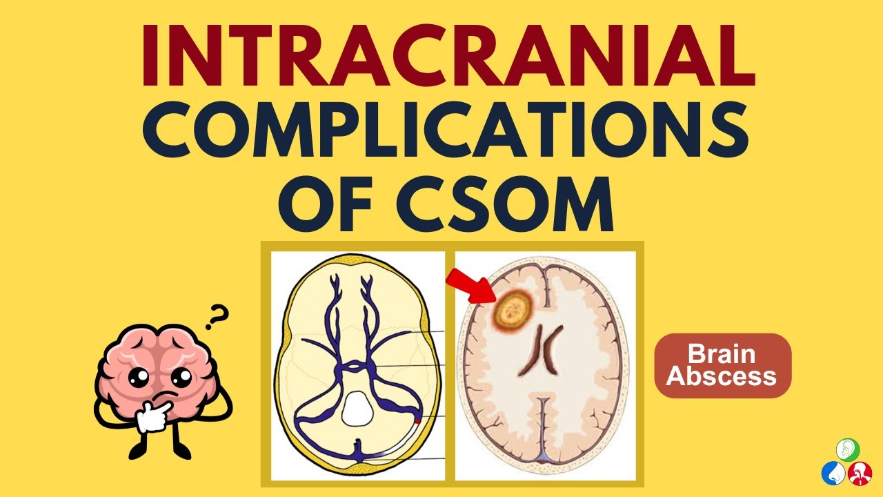 Intracranial Complications of Chronic Suppurative Otitis Media (CSOM) | Part 3