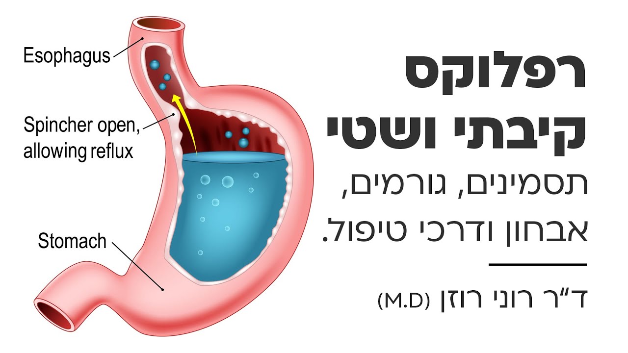 רפלוקס קיבתי ושטי: גורמים, תסמינים, אבחון ודרכי טיפול