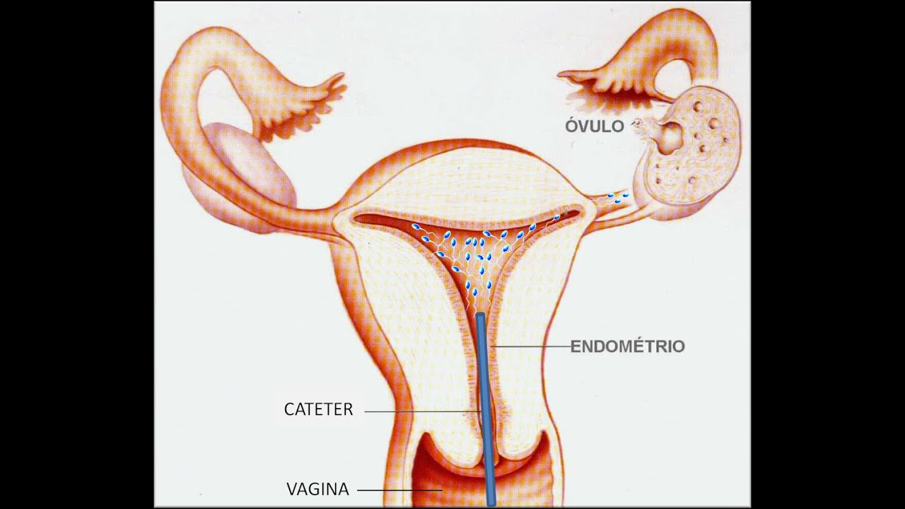 Inseminação Artificial (Inseminação Intra uterina)