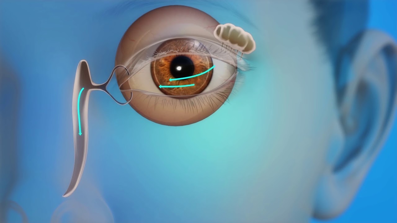 Ašarų kanalų (latakų) laidumo atstatymas Hila centre Vilniuje