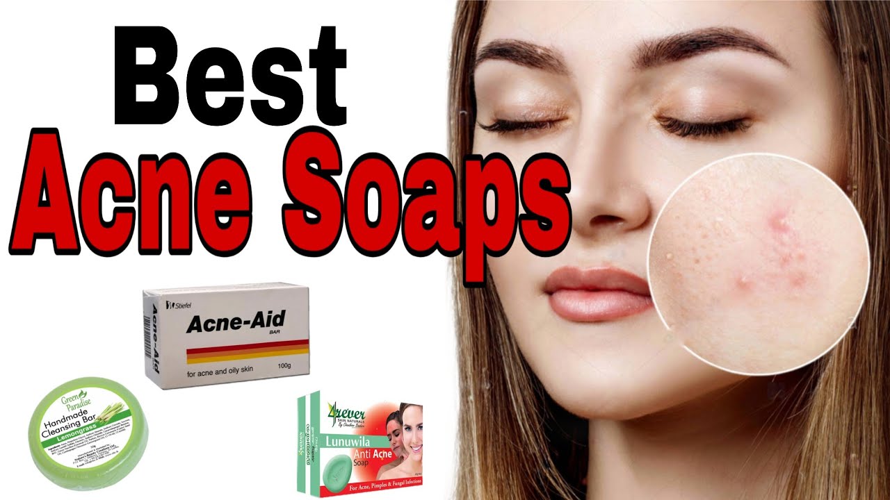Top 13 Soaps for Acne 2020| Best Soap Bars for Oily, Acne prone skin & Blackheads| Sri Lanka