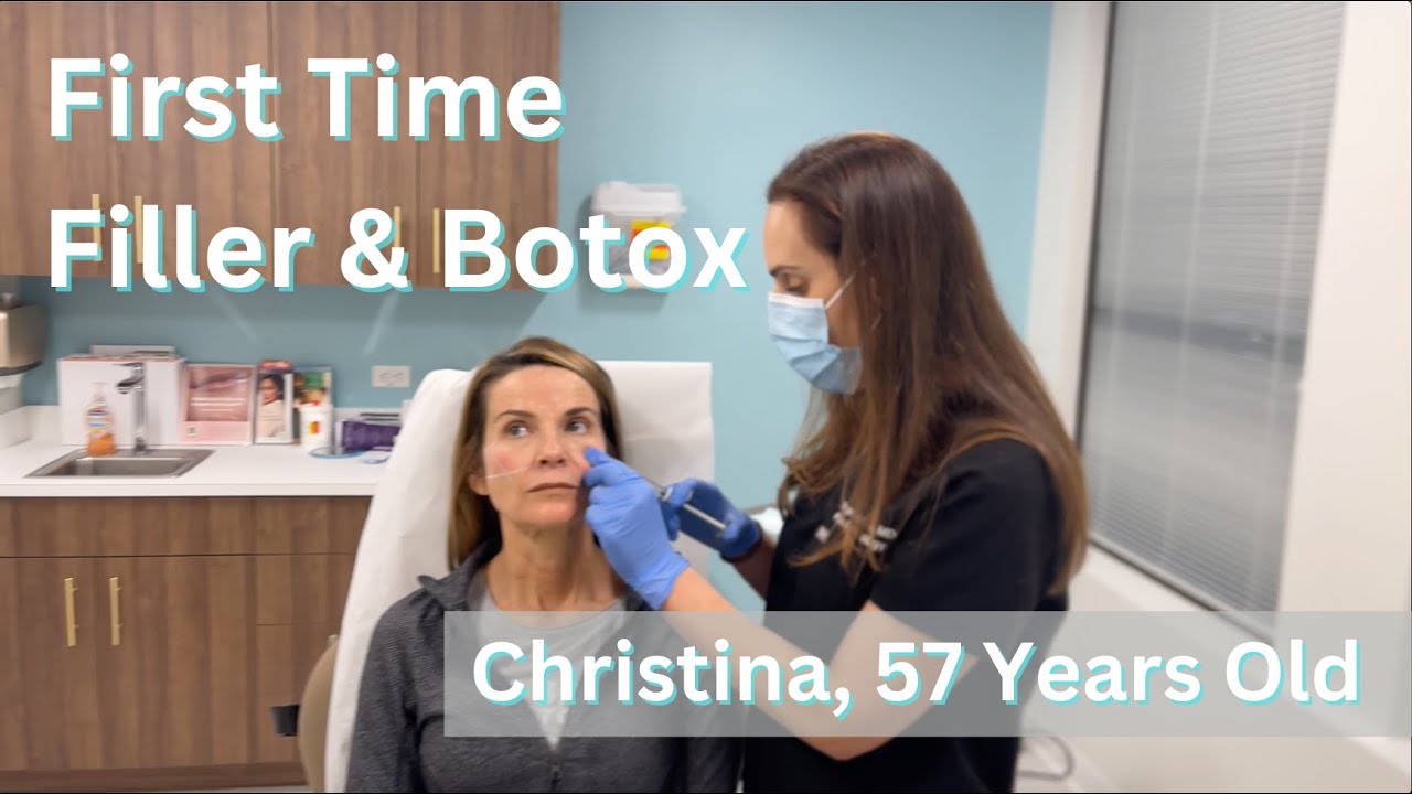 First Time Filler and Botox Patient With Natural Results