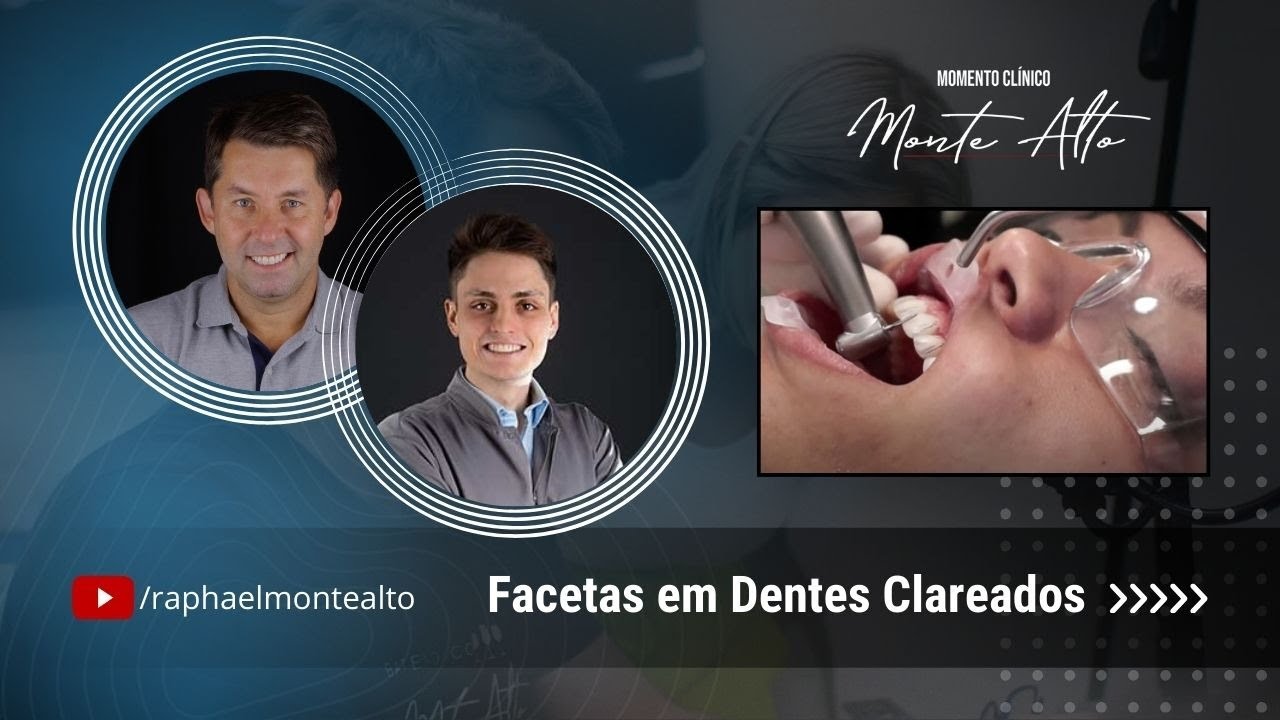 Facetas em Dentes Clareados com Renato Voss Rosa
