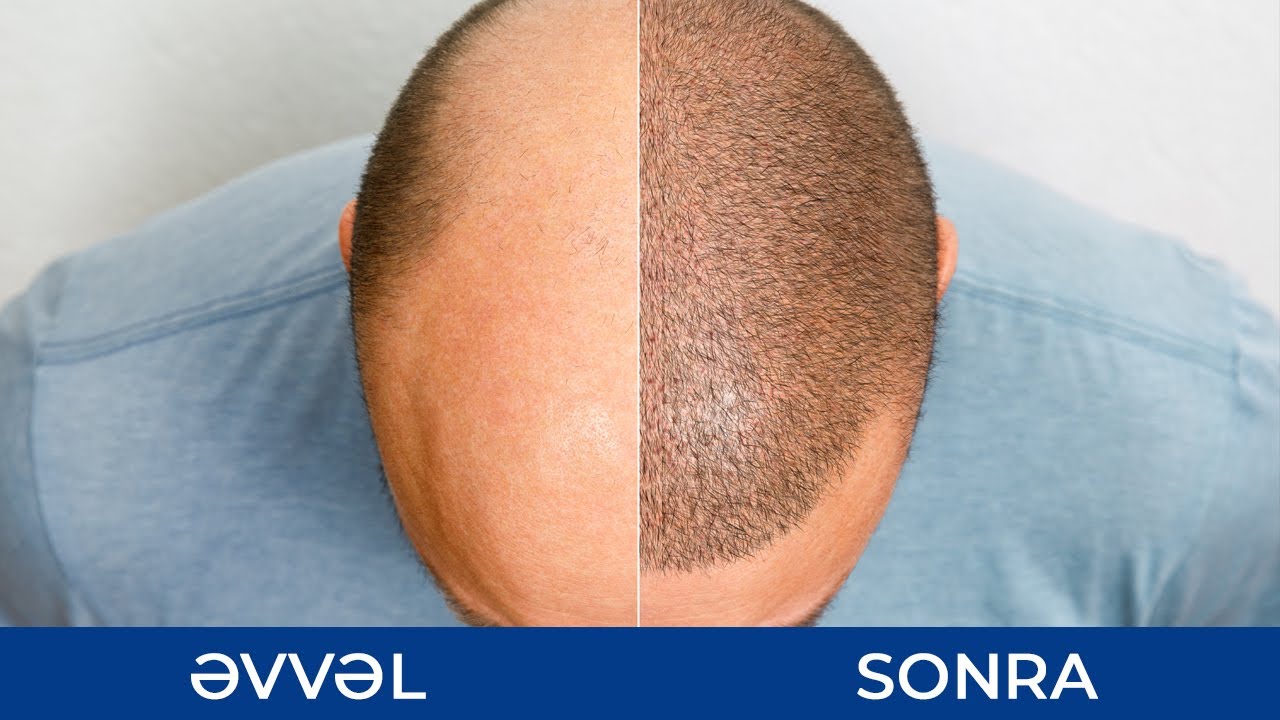 Saç Əkimindən Sonra - Natural Nəticələr  - Ramil Qocayev (Dermatoveneroloq-kosmetoloq)