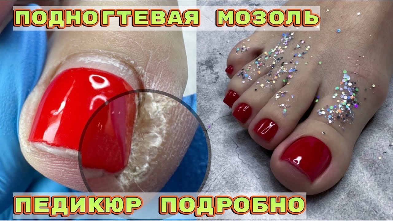 Как удалить подногтевую мозоль 🦶Педикюр подробно