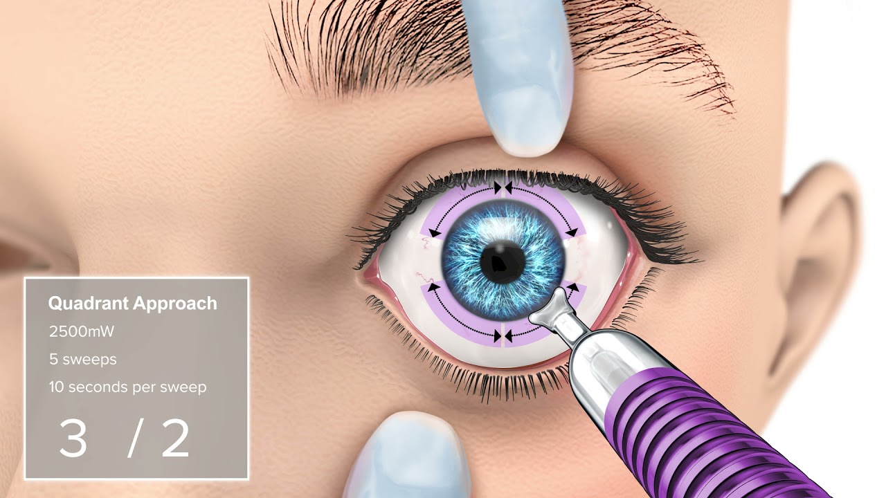 MicroPulse TLT with MicroPulse P3 Probe: Quadrant Approach