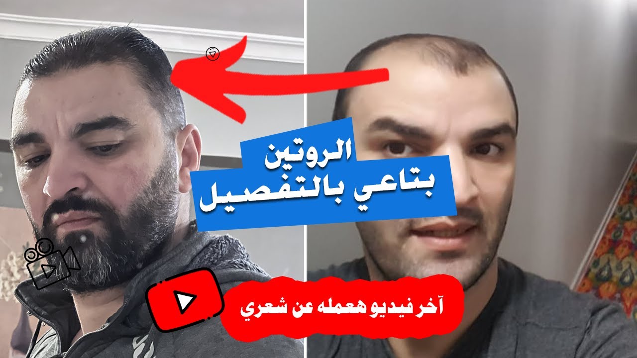 تجربتي مع علاج الصلع الوراثي | اقوى منتجات وروتين علاج الصلع الوراثي على الاطلاق والنتيجة مذهلة