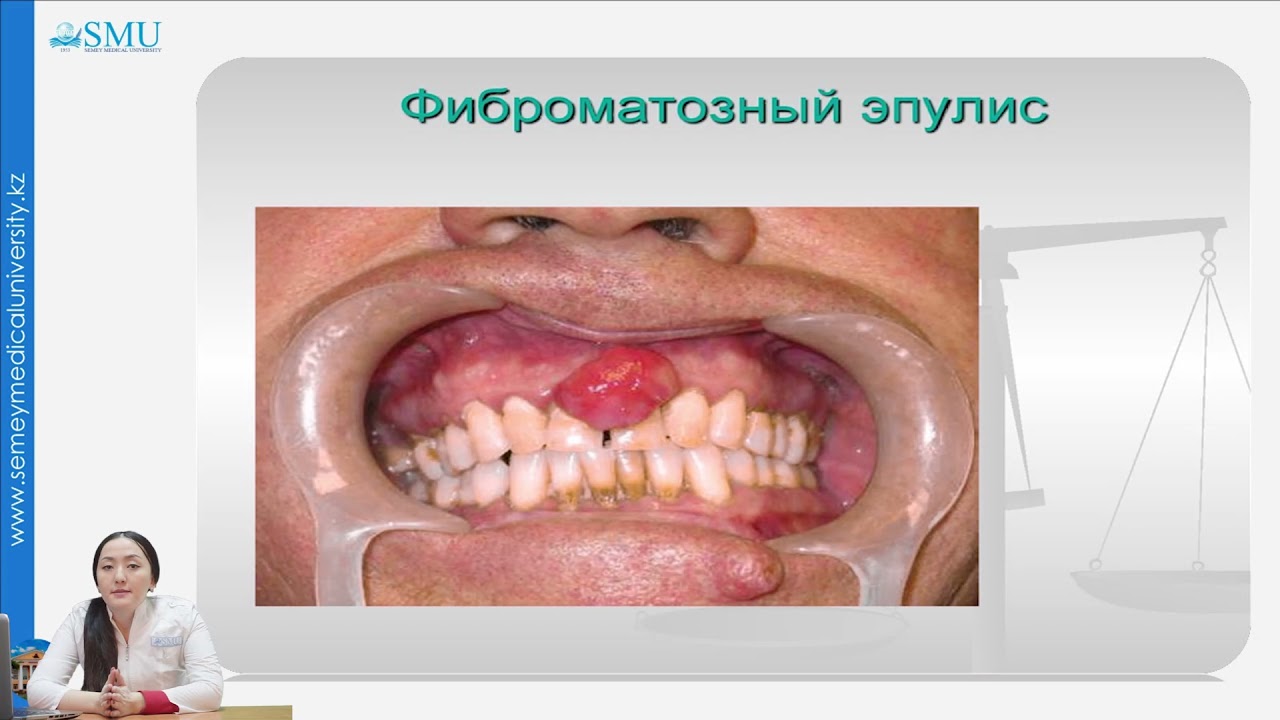 ПАРОДОНТОМЫ