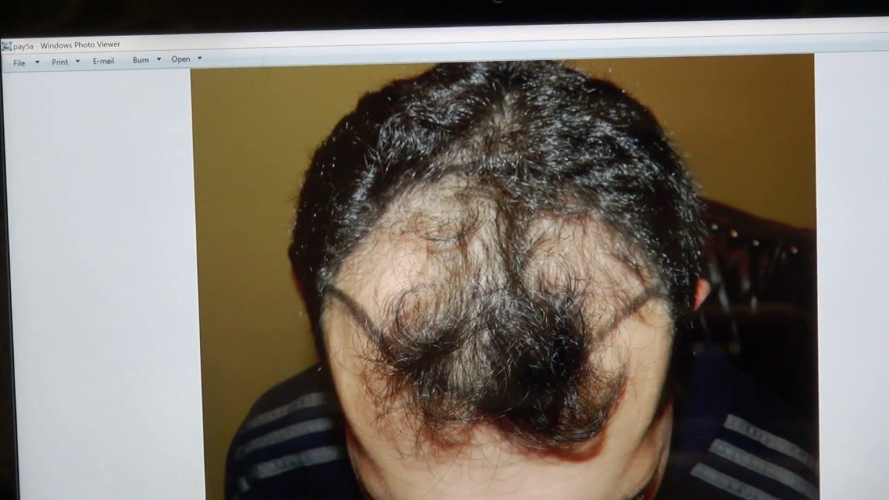 San Francisco Follicular Unit Extraction FUE Hair Restoration Result Dr. Diep www.mhtaclinic.com