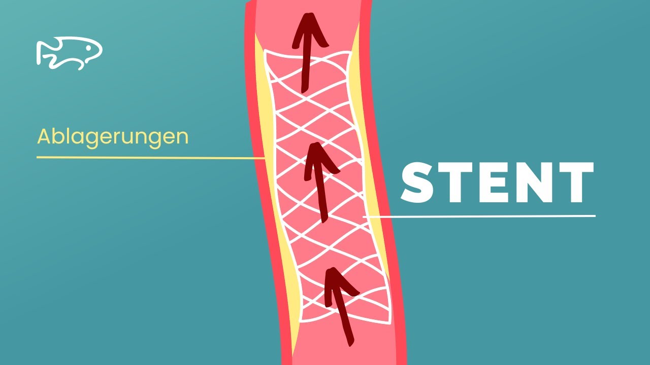 Stents: die unsichtbaren Helfer bei verstopften Gefäßen 🛡️ – Ursachen, OP-Ablauf und Risiken.