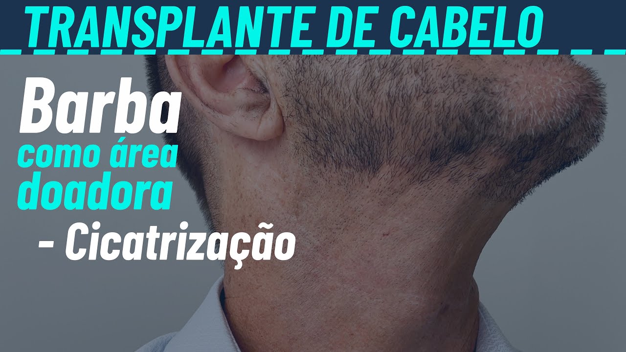 Transplante capilar usando a barba - cicatrização