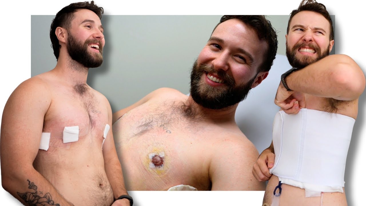My Post OP Recovery & Results | Top Surgery Vlog Part 2