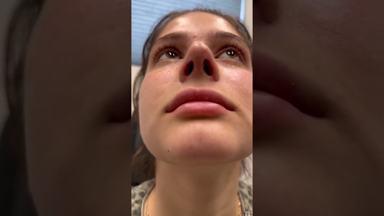Her First Nose Job Went WRONG… Here’s What We Did 😳 | Revision Rhinoplasty Reveal 