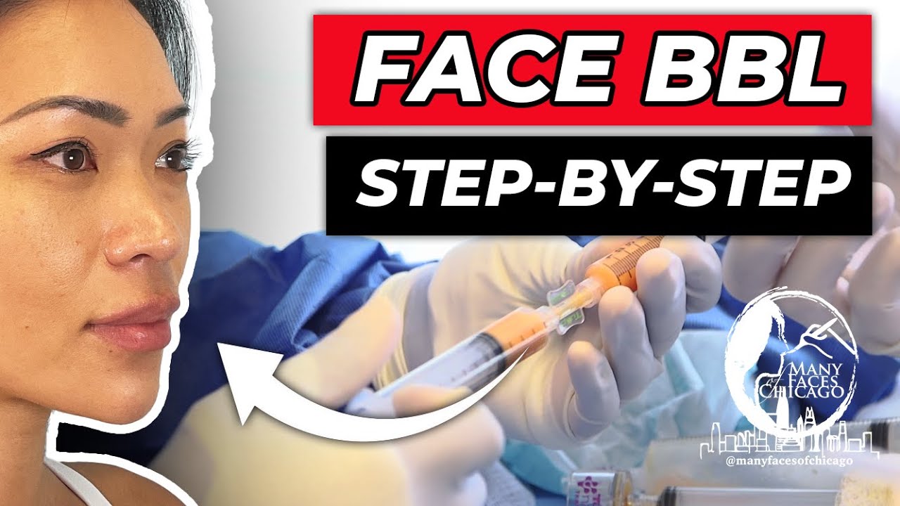FaceBBL Step-by-Step | Dr. Caughlin Explains | Face Fat Transfer @ Many Faces of Chicago #facebbl