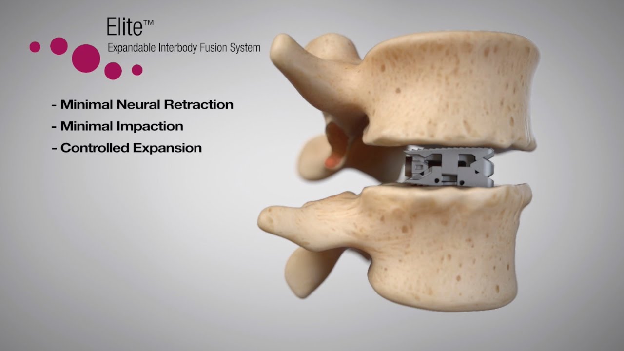 Elite™ Expandable Interbody Fusion System Animation