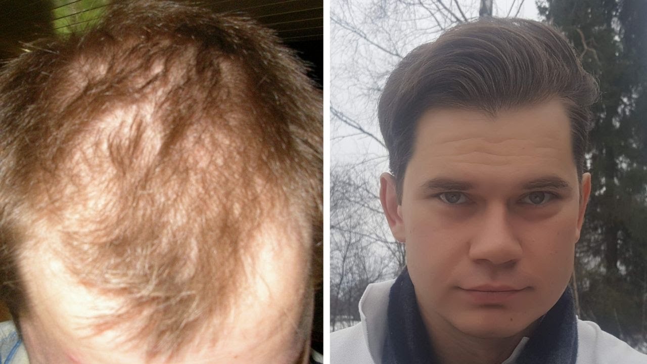 Is NO POO Good For Hair? Or Does NO POO Cause Hairloss?