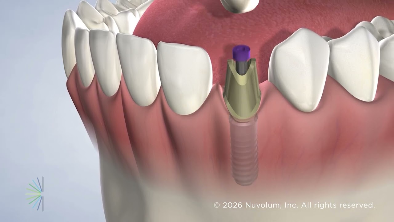 Dental Implants in St. Petersburg, FL