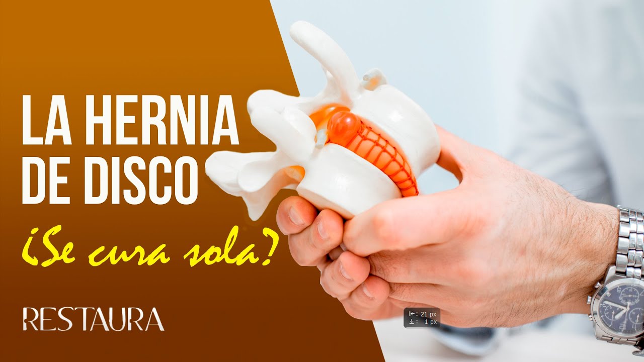 La hernia de disco &iquest;Se cura sola?
