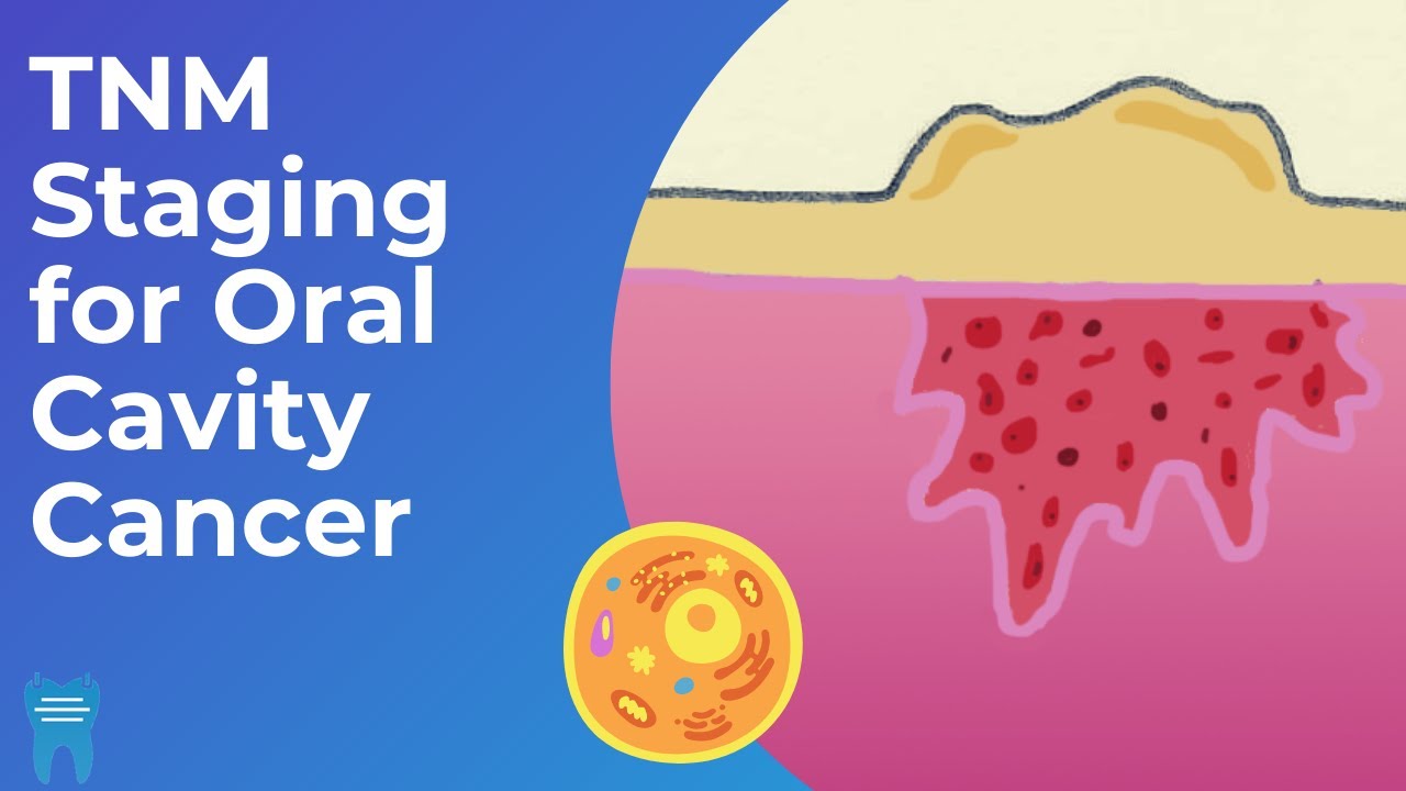 How do we stage oral cancer? | TNM Classification and Staging for Oral Cavity Cancers