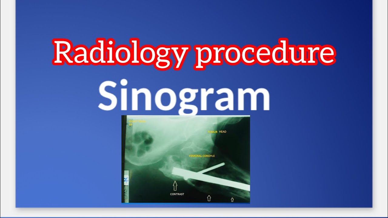 Sinogram | Radiographer Procedure | Ortho Procedure