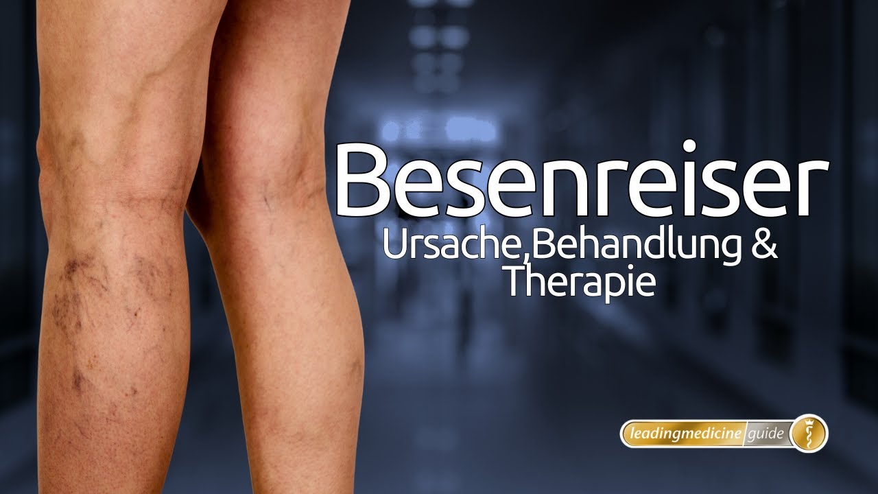 Laser oder Ver&ouml;dung? So werden Besenreiser heute professionell behandelt