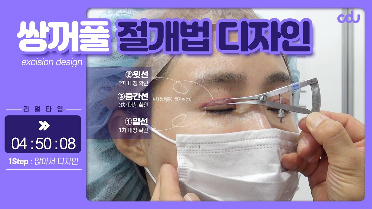 쌍꺼풀 수술 전 라인 디자인 공개_CDU청담유