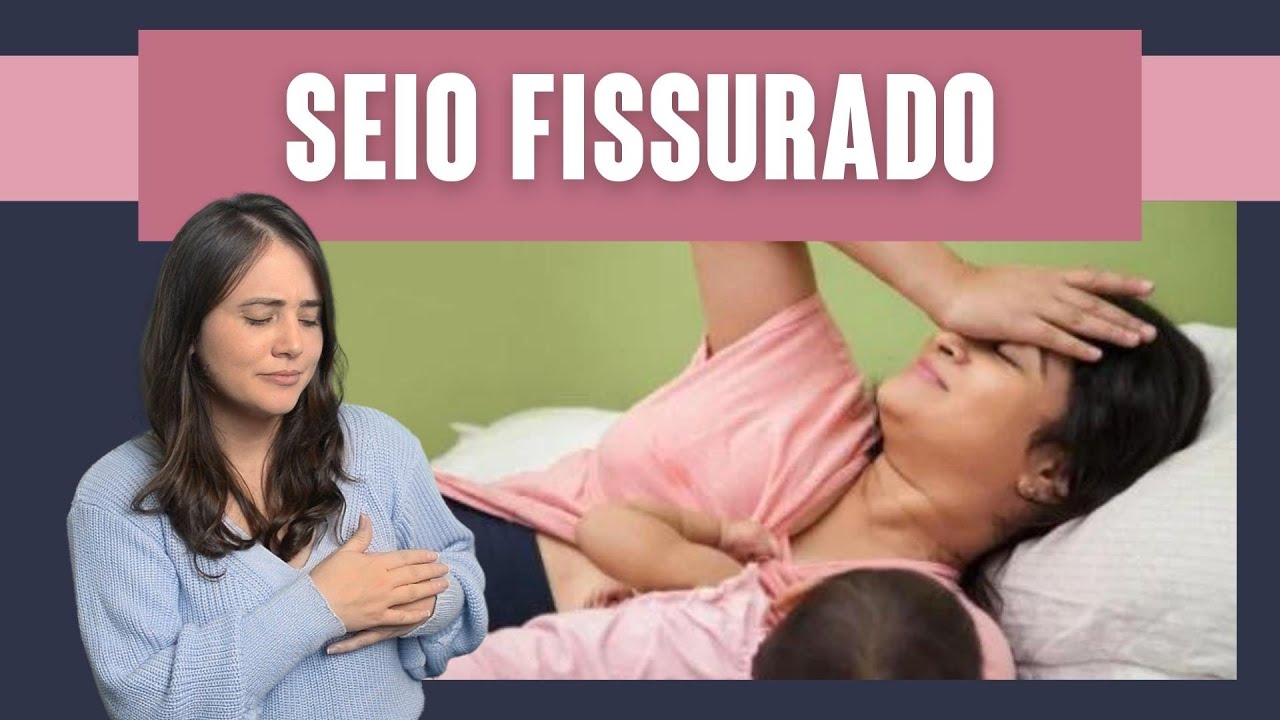 FISSURA NO SEIO | AMAMENTA&Ccedil;&Atilde;O