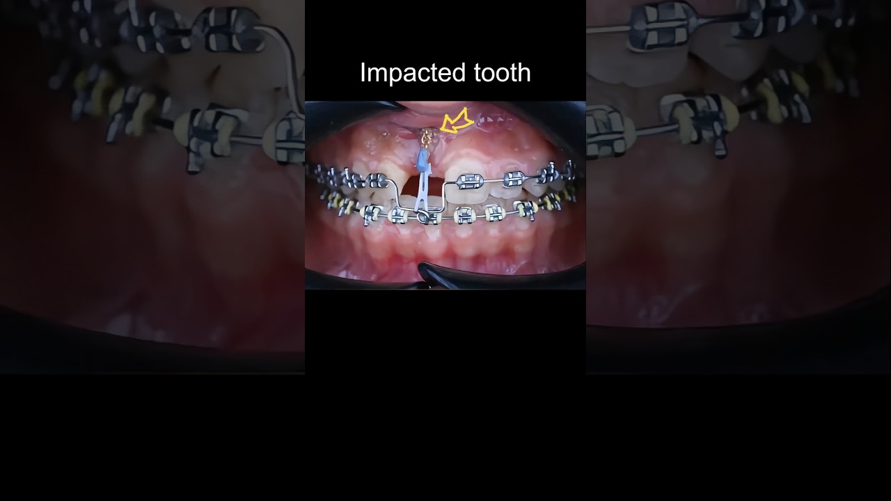 Using braces to pull out impacted teeth #braces #dentist