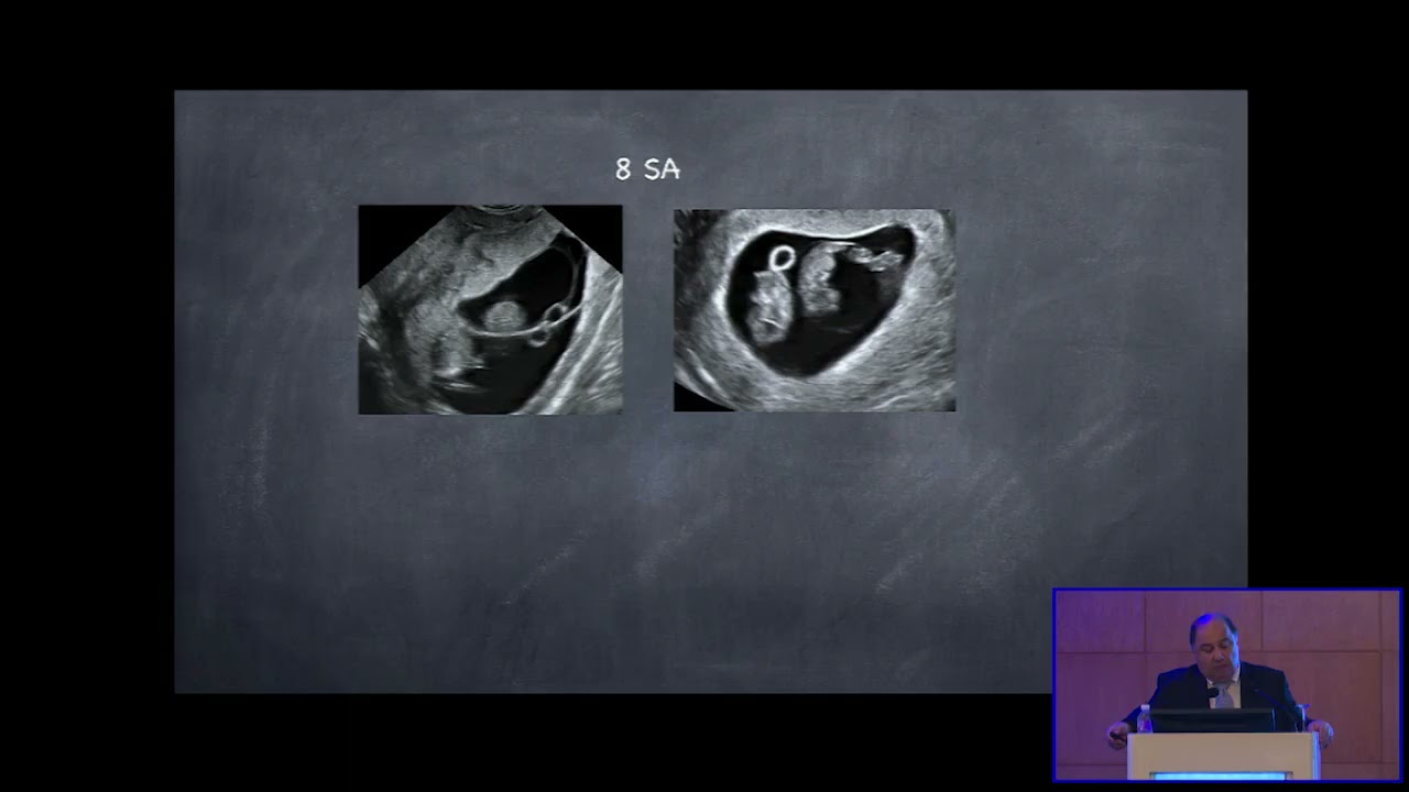 Diagnostic de chorionicité et surveillance des GG monochoriales