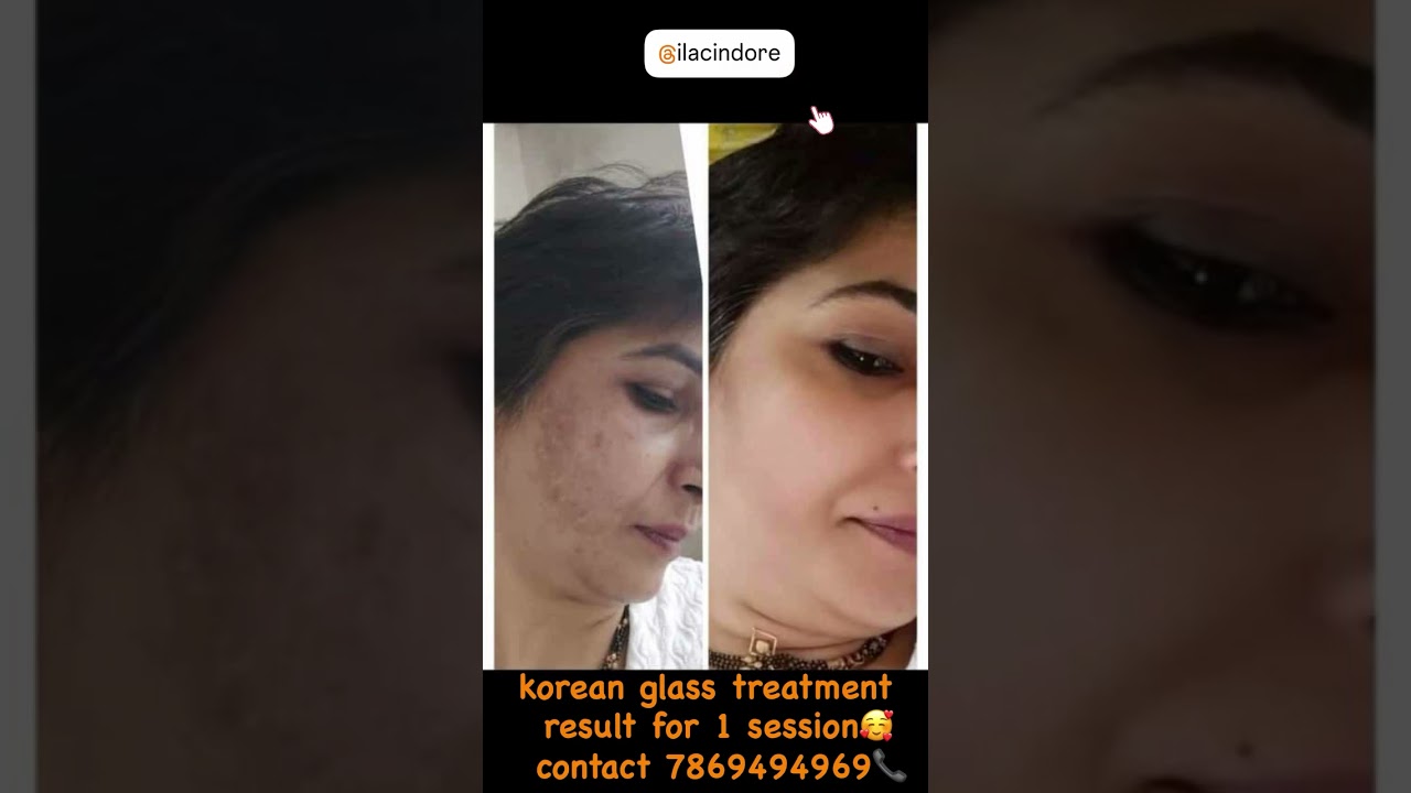 Korean Glass Skin Treatment – Real Results, Real Glow! 