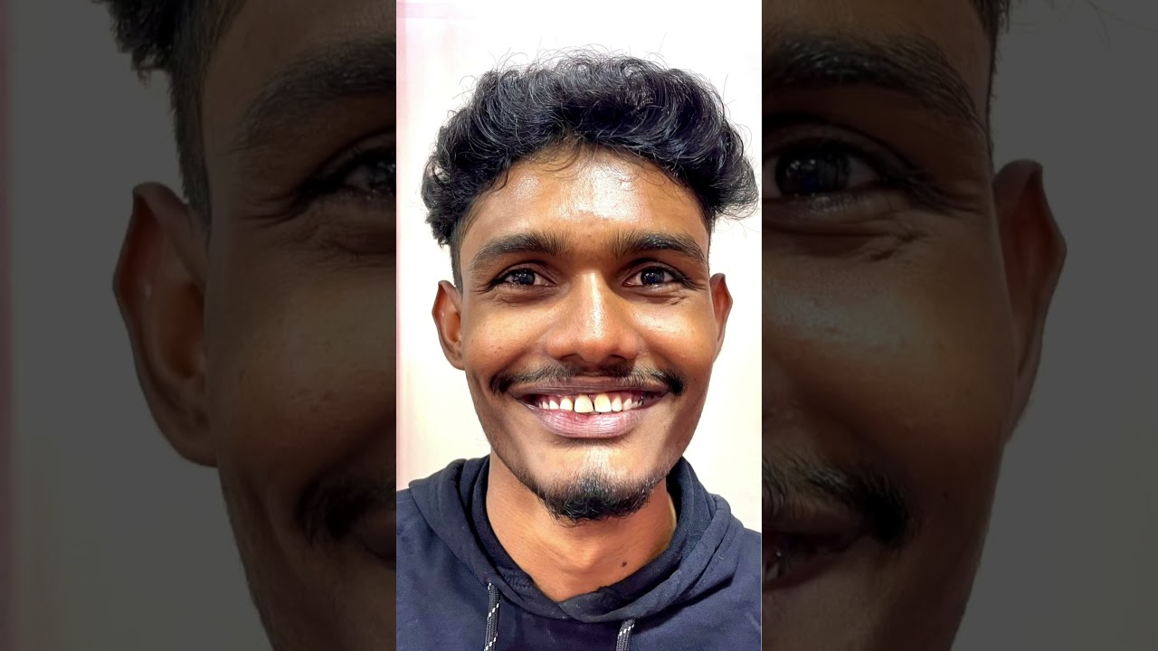 Missing tooth replacement with Same day Implant, Cap. 