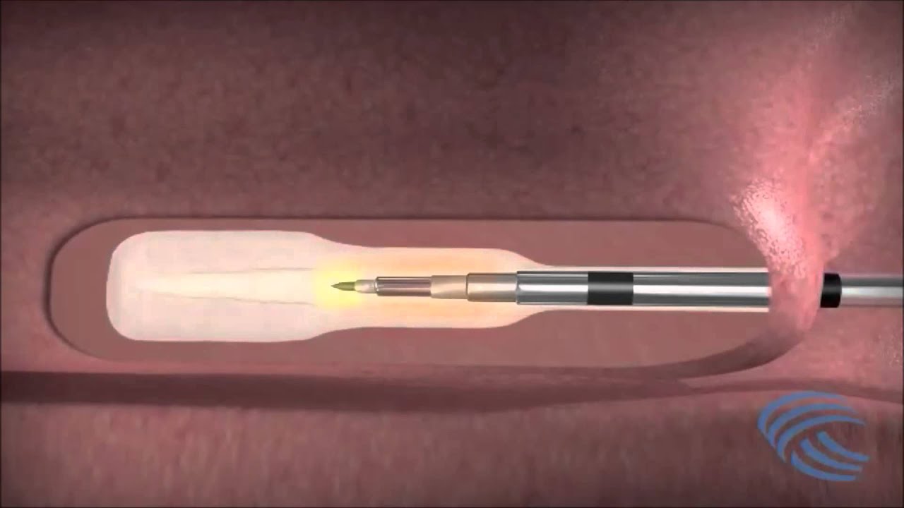 COBLATION&loz; Turbinate Reduction - REFLEX ULTRA&loz;