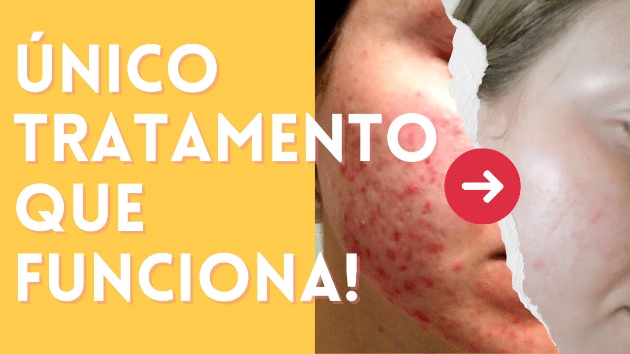 Quais Produtos Usar para ELIMINAR A ACNE FÚNGICA? | Rotina passo a passo para limpar sua pele ✨